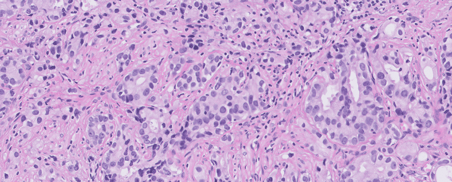 Deep Bio and Visiopharm announce a collaborative integration of a clinical-grade AI prostate cancer solution with a leading digital pathology platform