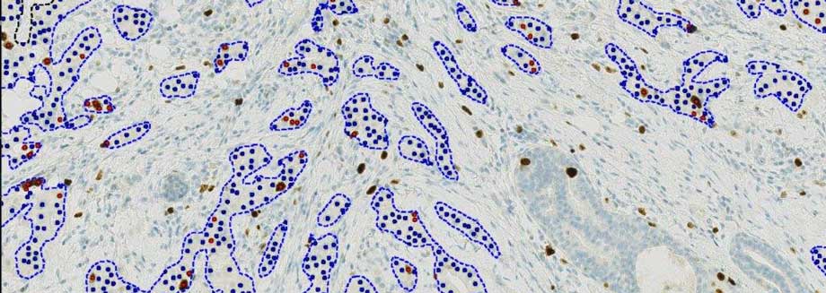 Visiopharm launches IVDR-cleared and fully automated next-generation Ki67 algorithm for IHC biomarker analysis
