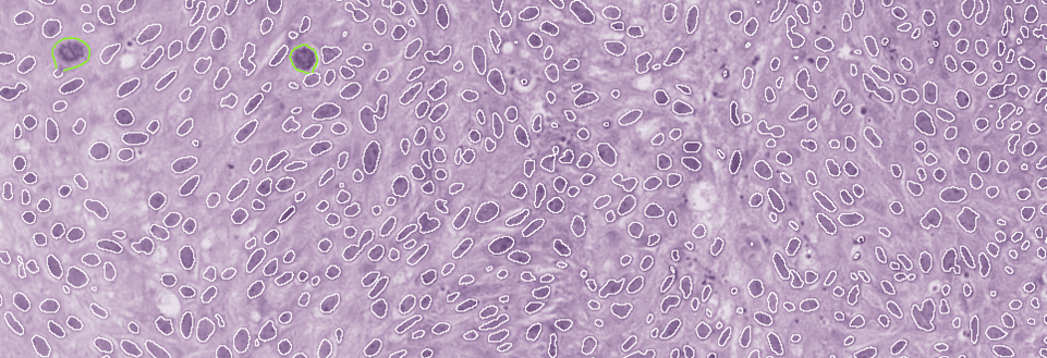 Improving bladder cancer grading with AI-driven image analysis: A conversation with Prof. David Berman